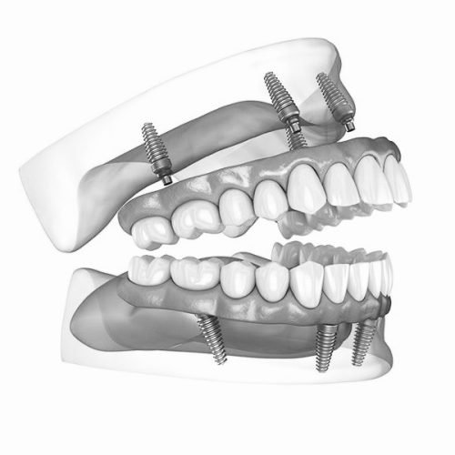 Dantų atkūrimas 4 implantais