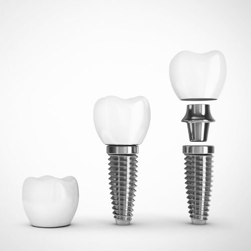 Dantų implantacija