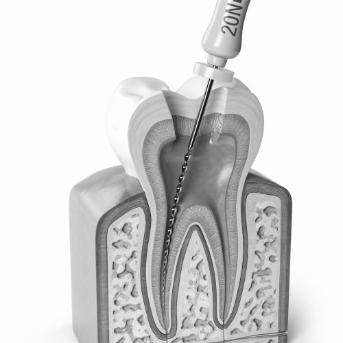 Endodontinis gydymas
