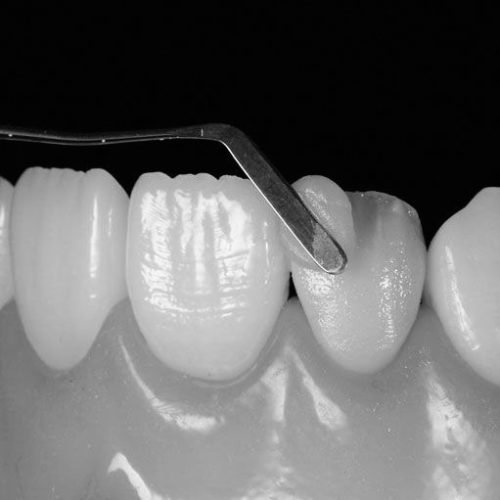 Estetinis plombavimas