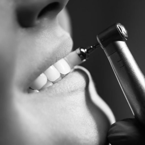 Profesionali burnos higiena